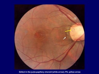 Defect in the juxta-papillary choroid (white arrow); Pit, yellow arrow
 