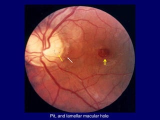 Pit, and lamellar macular hole
 