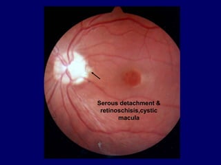 Serous detachment &
retinoschisis,cystic
macula
 
