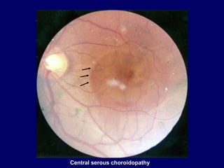 Central serous choroidopathy
 