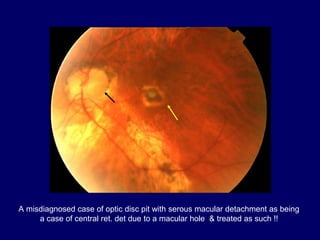 A misdiagnosed case of optic disc pit with serous macular detachment as being
a case of central ret. det due to a macular hole & treated as such !!
 