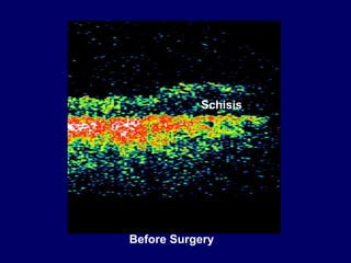 Schisis
Before Surgery
 