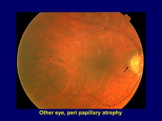 Other eye, peri papillary atrophy
 