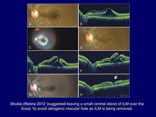 Shukla (Retina 2012 )suggested leaving a small central island of ILM over the
fovea “to avoid iatrogenic macular hole as ILM is being removed
 