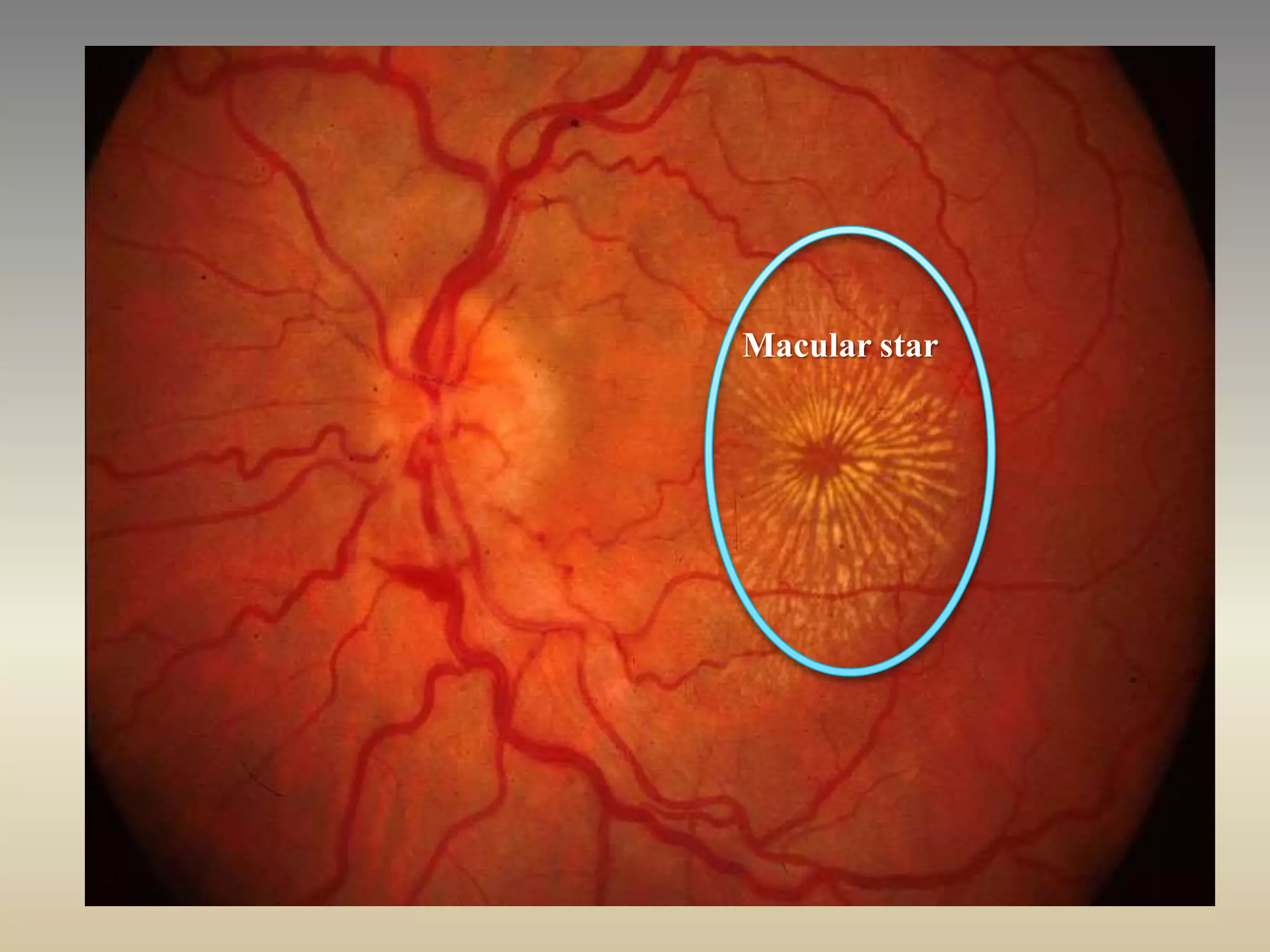 Optic Nerve And Its Disorders PPTX