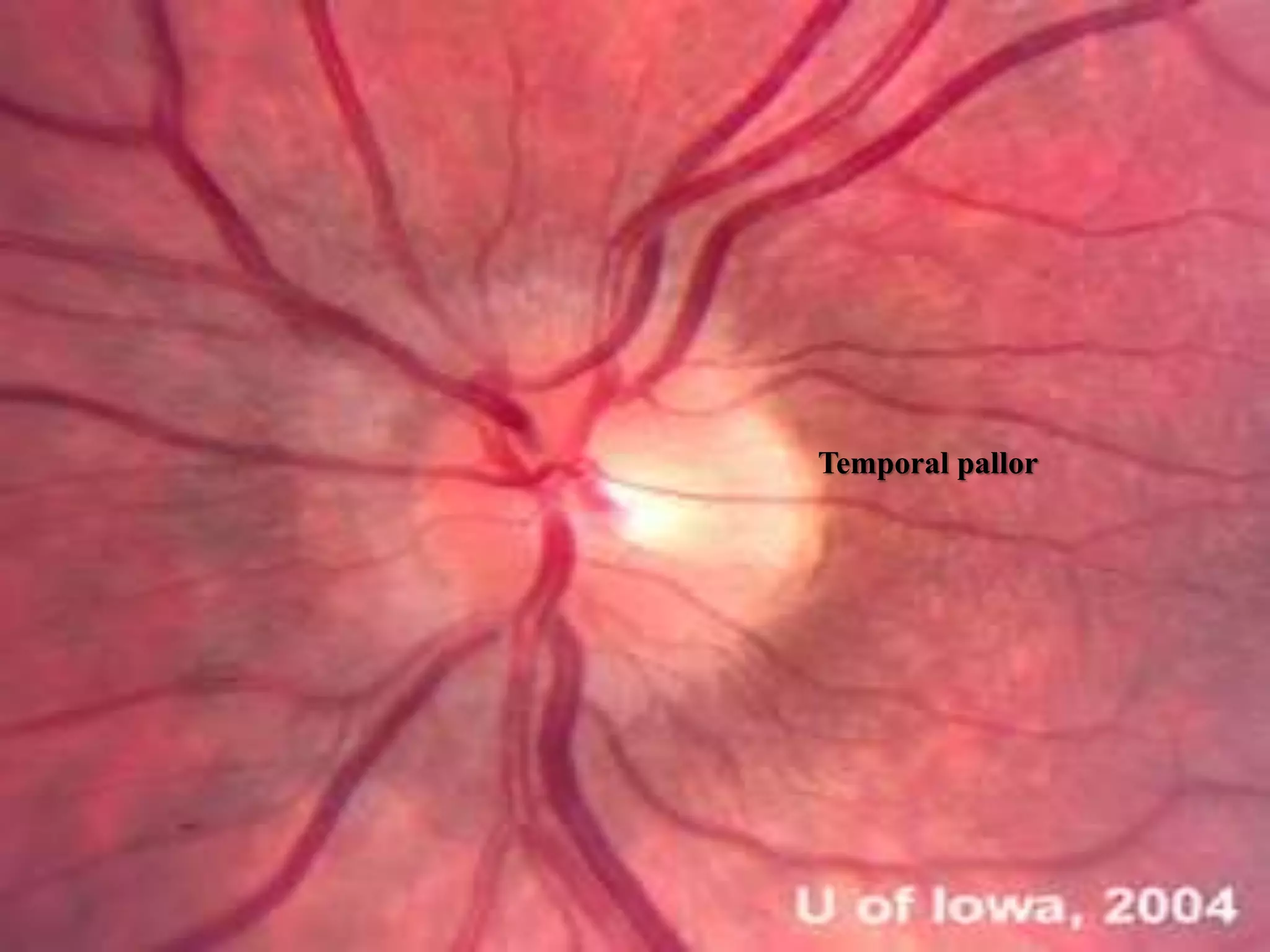 Optic nerve and its disorders | PPTX