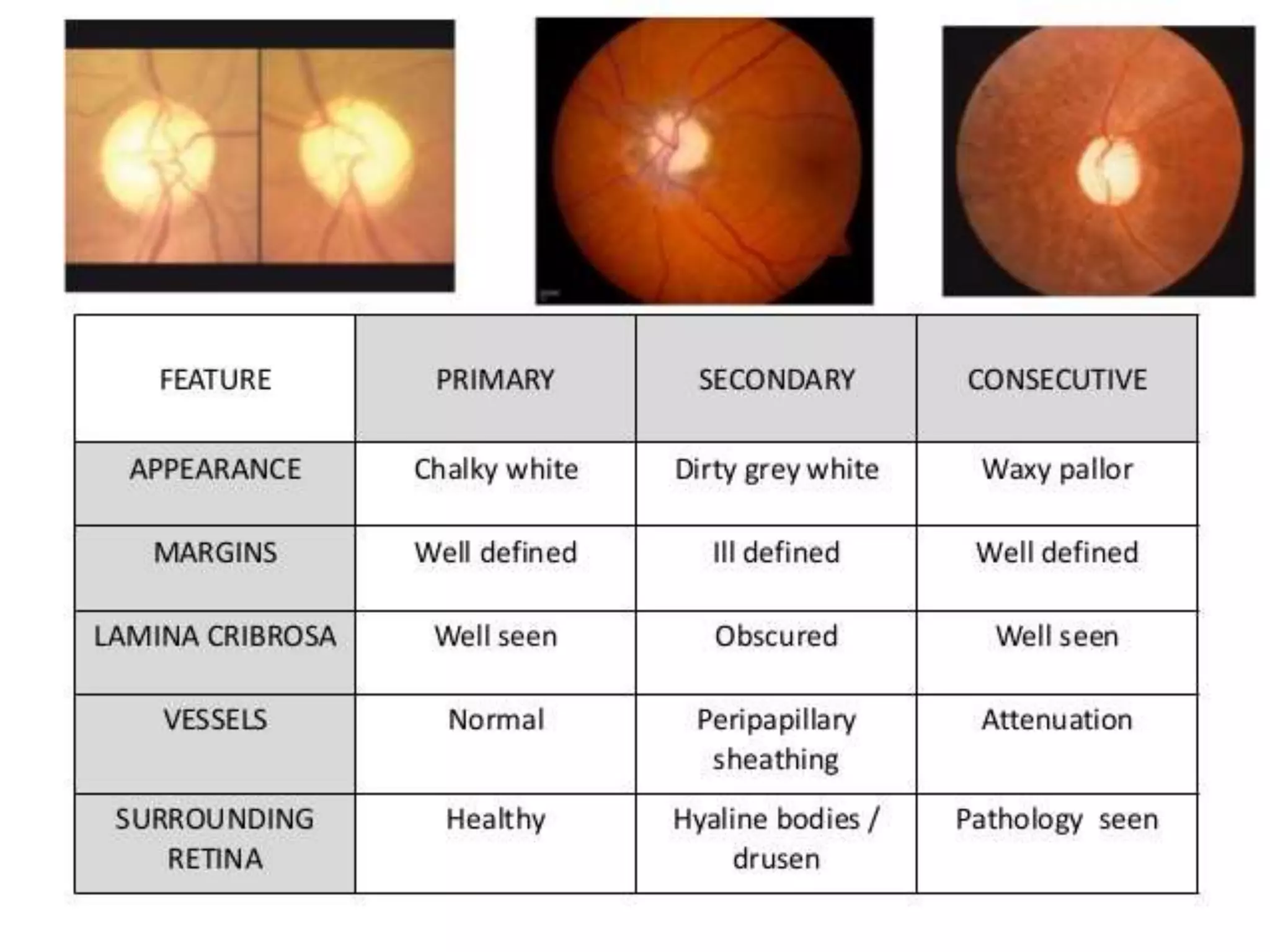 Optic nerve and its disorders | PPTX
