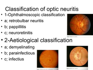 Classification of optic neuritis 1-Ophthalmoscopic classification a; retrobulbar neuritis  b; pappillitis  c; neuroretinitis  2-Aetiological classification a; demyelinating b; parainfectious c; infectius  
