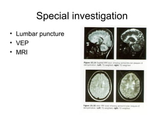 Special investigation Lumbar puncture VEP MRI 