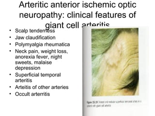 Arteritic anterior ischemic optic neuropathy: clinical features of giant cell arteritis Scalp tenderness Jaw claudification Polymyalgia rheumatica Neck pain, weight loss, anorexia fever, night sweets, malaise depression Superficial temporal arteritis  Arteitis of other arteries Occult arterritis 
