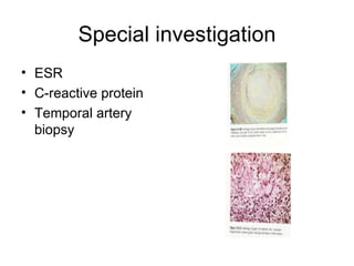 Special investigation ESR C-reactive protein  Temporal artery biopsy 