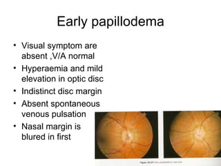 Early papillodema Visual symptom are absent ,V/A normal Hyperaemia and mild elevation in optic disc Indistinct disc margin Absent spontaneous venous pulsation Nasal margin is blured in first 