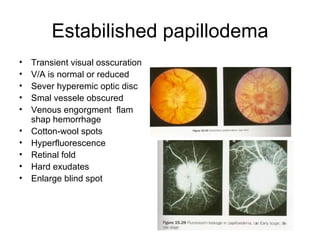 Estabilished papillodema Transient visual osscuration V/A is normal or reduced  Sever hyperemic optic disc Smal vessele obscured Venous engorgment  flam shap hemorrhage Cotton-wool spots Hyperfluorescence Retinal fold Hard exudates Enlarge blind spot 