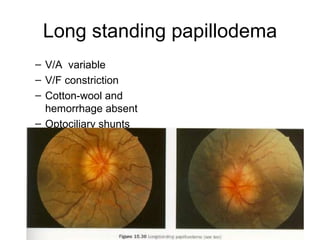 Long standing papillodema V/A  variable V/F constriction Cotton-wool and hemorrhage absent Optociliary shunts 