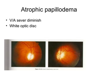 Atrophic papillodema V/A sever diminish White optic disc 