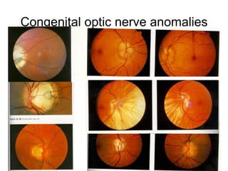 Congenital optic nerve anomalies 