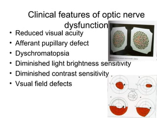 Clinical features of optic nerve dysfunction Reduced visual acuity Afferant pupillary defect Dyschromatopsia Diminished light brightness sensitivity Diminished contrast sensitivity Vsual field defects 