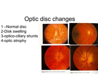 Optic disc changes 1 –Normal disc 2-Disk swelling  3-optico-ciliary shunts 4-optic atrophy 