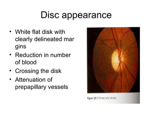 Disc appearance  White flat disk with clearly delineated mar gins  Reduction in number of blood Crossing the disk  Attenuation of prepapillary vessels  