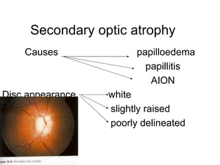 Secondary optic atrophy  Causes  papilloedema papillitis AION Disc appearance  white slightly raised poorly delineated margin 