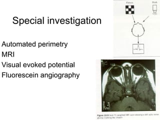 Special investigation Automated perimetry MRI Visual evoked potential Fluorescein angiography 