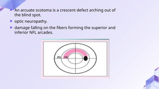 Arching Defect optic nerve clinical research examination.pptx