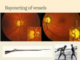Optic Nerve Head Evaluation for glaucoma | PPTX