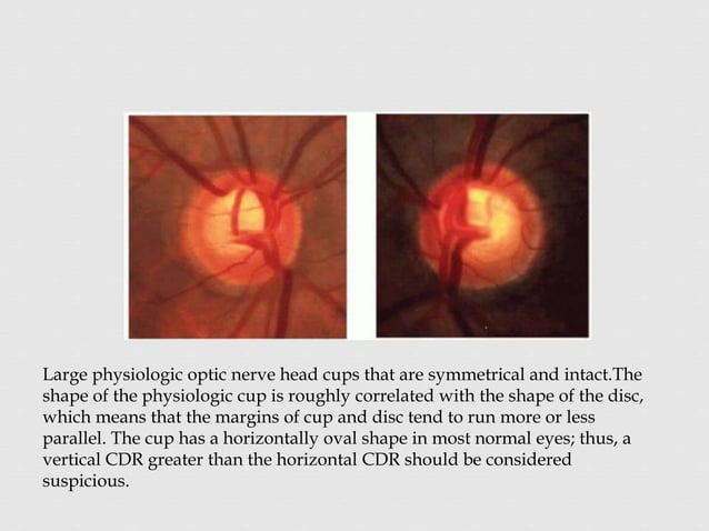 Optic nerve head evaluation in glaucoma | PPTX | Eye and Vision ...