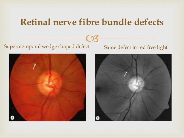 Optic nerve head evaluation in glaucoma