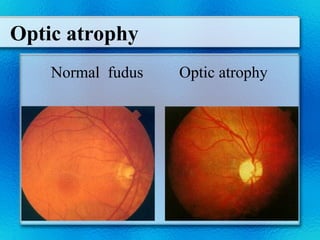 OPtic nerve OK Neuro-ophthalmology for MBBs | PPT
