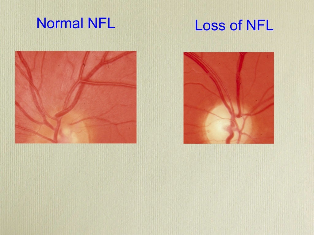 Optic neuritis