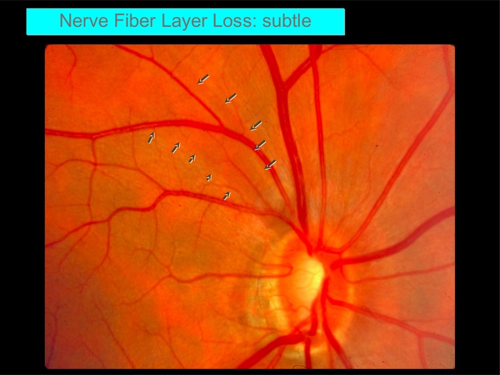 Optic neuritis