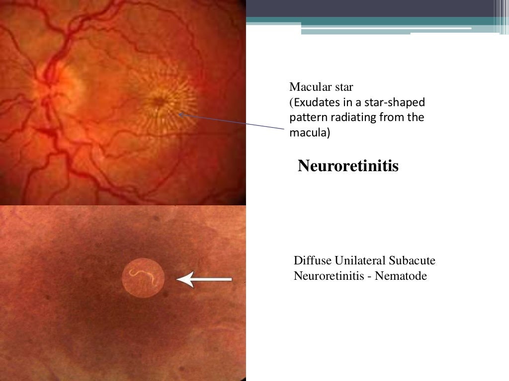 Optic neuritis