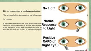 Optic neuritis | PPTX