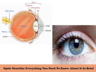 Optic Neuritis: Everything You Need To Know About It In Brief
 