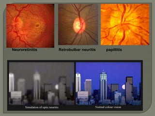 papillitis
Neuroretinitis Retrobulbar neuritis
 