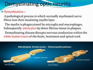 Demyelinating Process optic neuritis ppt presentation by Dr Usman | PPTX