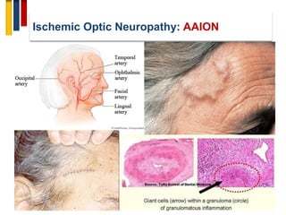 Optic neuropathy | PDF