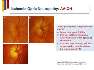 Optic neuropathy | PDF