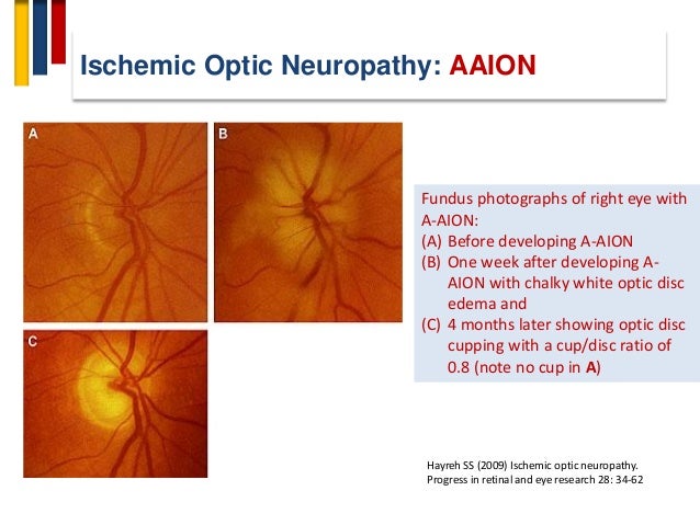 Optic Neuropathy