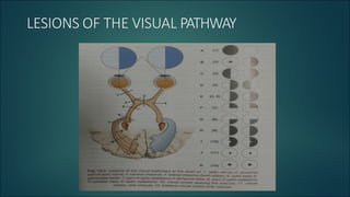 LESIONS OF THE VISUAL PATHWAY
 