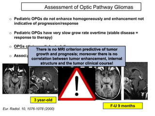 Optic pathway glioma | PPTX