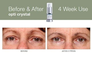 CosMedix Opti Crystal Before and After Results
