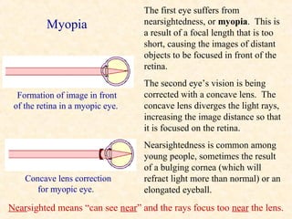 The first eye suffers from
          Myopia                  nearsightedness, or myopia. This is
                                  a result of a focal length that is too
                                  short, causing the images of distant
                                  objects to be focused in front of the
                                  retina.
                                  The second eye’s vision is being
  Formation of image in front     corrected with a concave lens. The
 of the retina in a myopic eye.   concave lens diverges the light rays,
                                  increasing the image distance so that
                                  it is focused on the retina.
                                  Nearsightedness is common among
                                  young people, sometimes the result
                                  of a bulging cornea (which will
    Concave lens correction       refract light more than normal) or an
       for myopic eye.            elongated eyeball.
Nearsighted means “can see near” and the rays focus too near the lens.
 