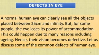 31
DEFECTS IN EYE
A normal human eye can clearly see all the objects
placed between 25cm and infinity. But, for some
people, the eye loses its power of accommodation.
This could happen due to many reasons including
ageing. Hence, their vision becomes defective. Let us
discuss some of the common defects of human eye.
 