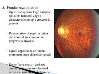 optics of ametropia123446788993455q.pptx