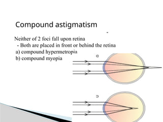 Compound Myopia Example optics of ametropia123446788993455q.pptx