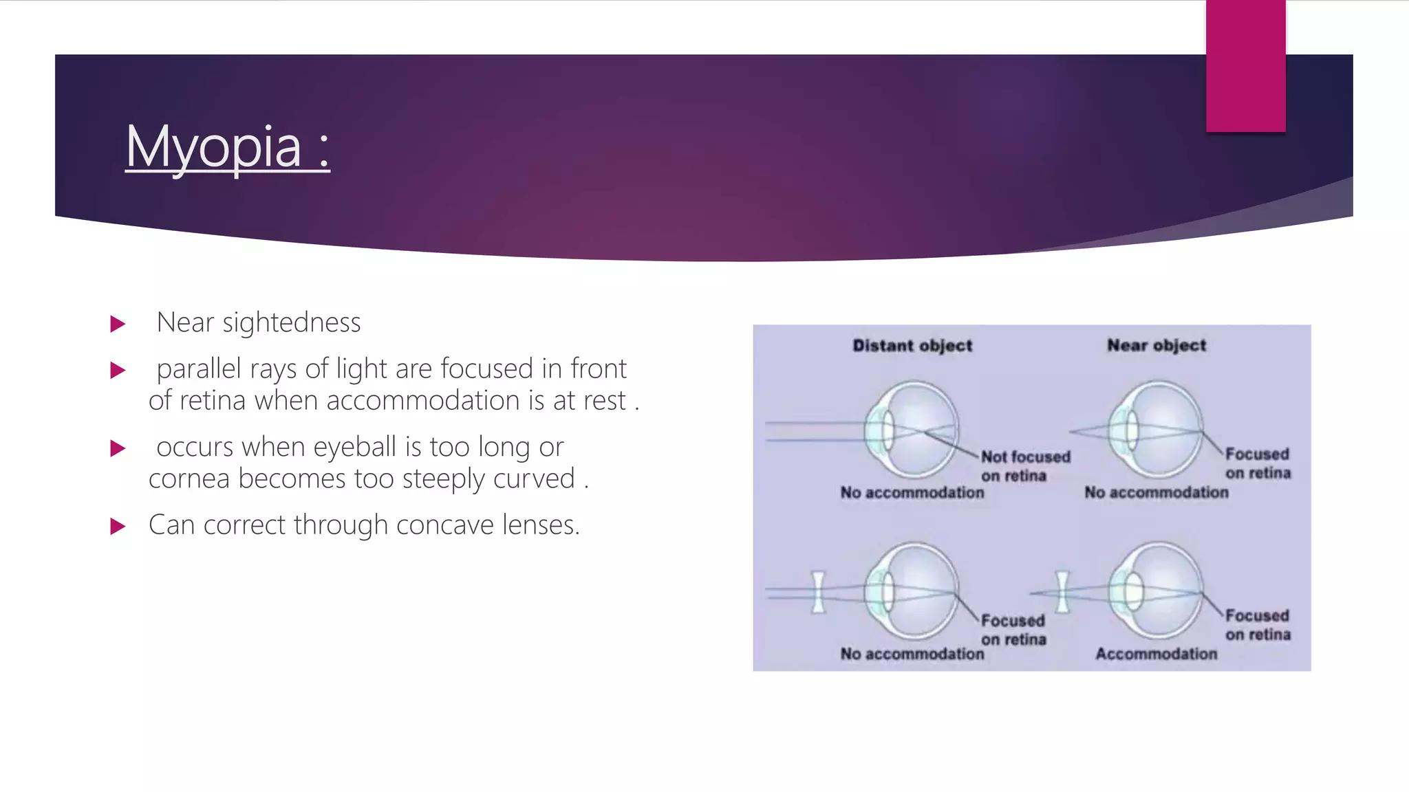 Myopia :
 Near sightedness
 parallel rays of light are focused in front
of retina when accommodation is at rest .
 occurs when eyeball is too long or
cornea becomes too steeply curved .
 Can correct through concave lenses.
 