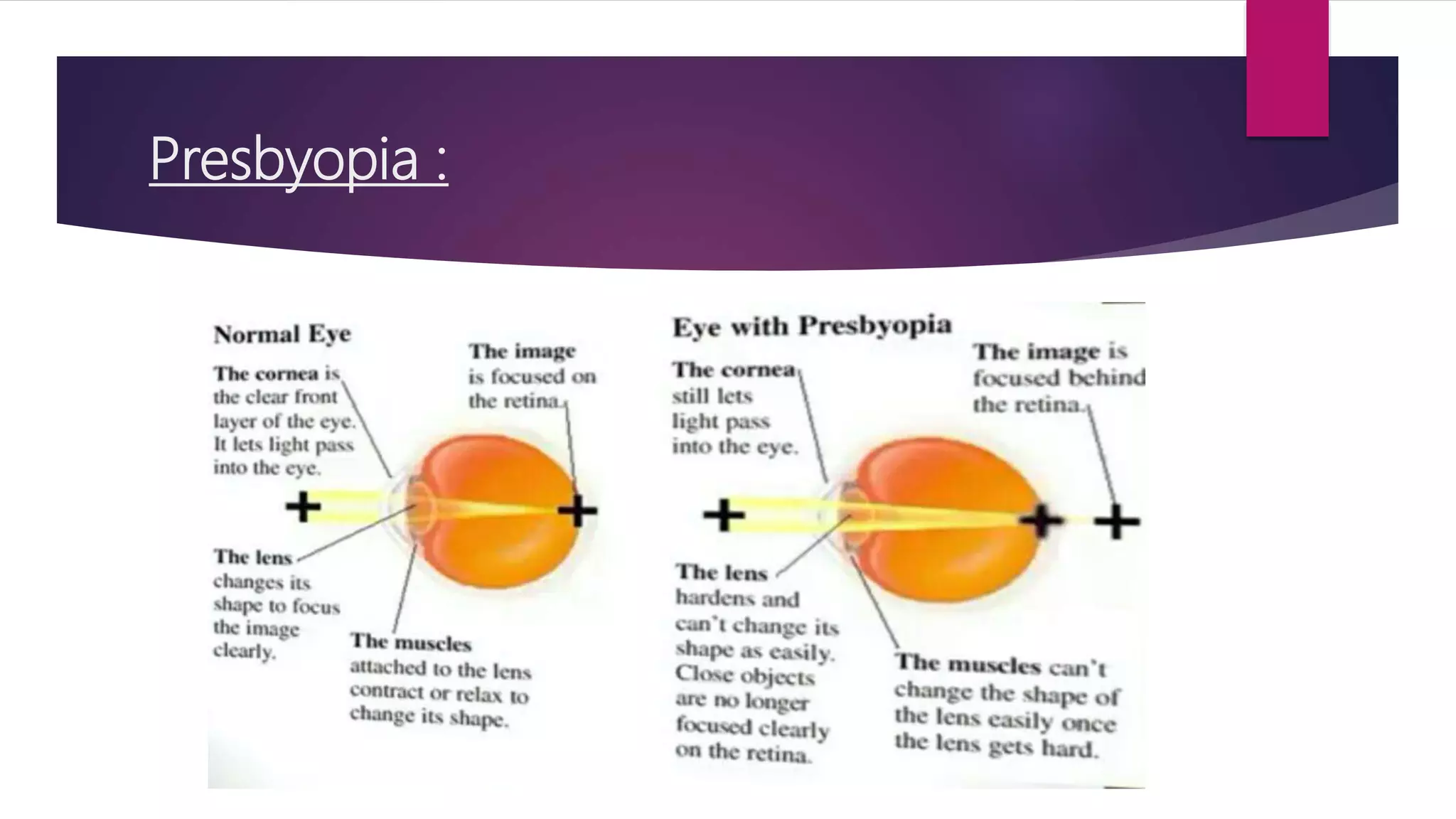 Presbyopia :
 