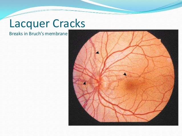 Optics Of Human Eye Refractive Errors Optics Of Human Eye Refractive Errors